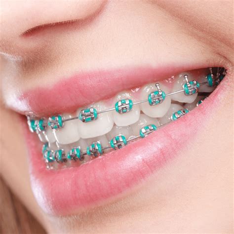 metal brackets for teeth|reason for braces on teeth.